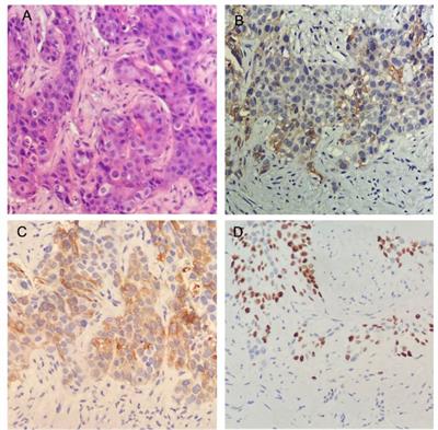 Squamous cell carcinoma of ascending colon with pMMR/MSS showed a partial response to PD-1 blockade combined with chemotherapy: A case report